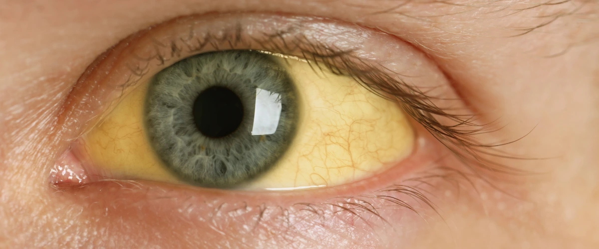olhos amarelados